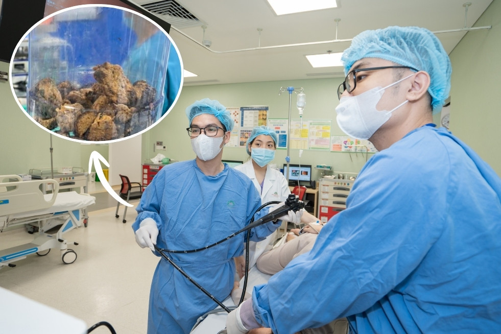 Nội soi lấy khối bã thức ăn ‘khổng lồ’ 15cm trong dạ dày