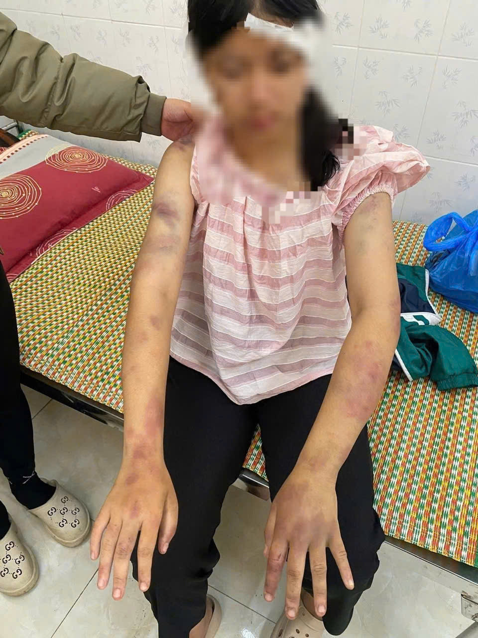 Cháu P.A với nhiều vết bầm tím trên cơ thể.jpg