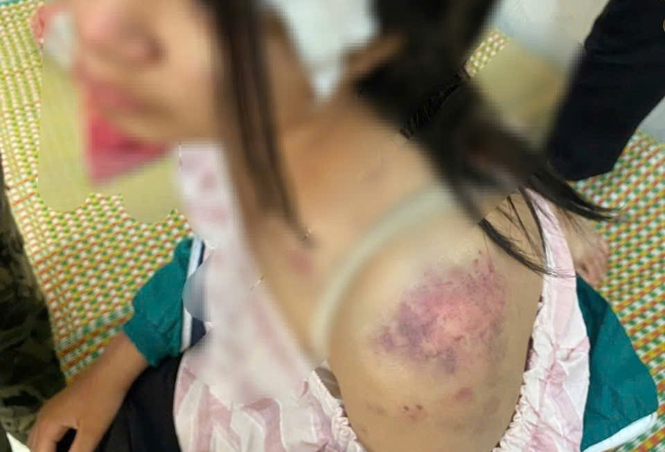 Sức khỏe bé gái bị bà nội và 2 người đàn ông bạo hành đến bầm tím khắp cơ thể