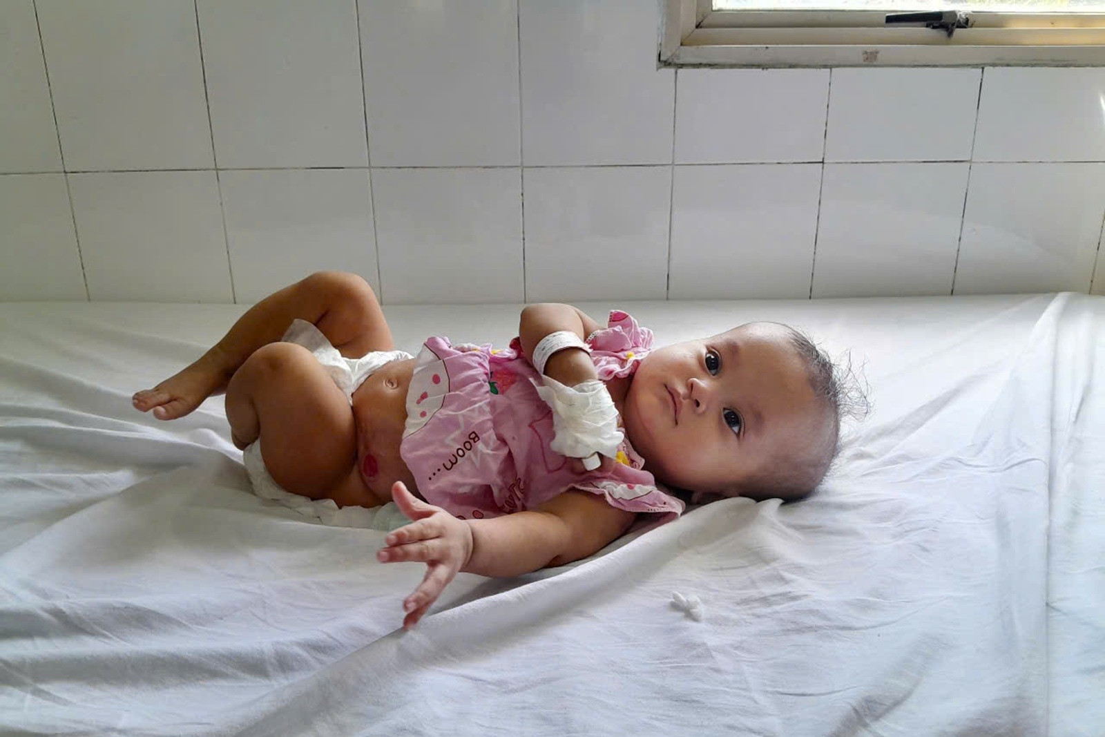 Bé gái 1 tuổi cần ghép thận gấp, cha mẹ nghèo mong có phép màu cứu con