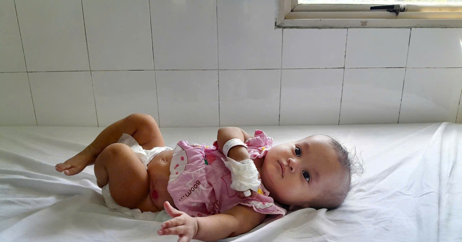 Bé gái 1 tuổi cần ghép thận gấp, cha mẹ nghèo mong có phép màu cứu con