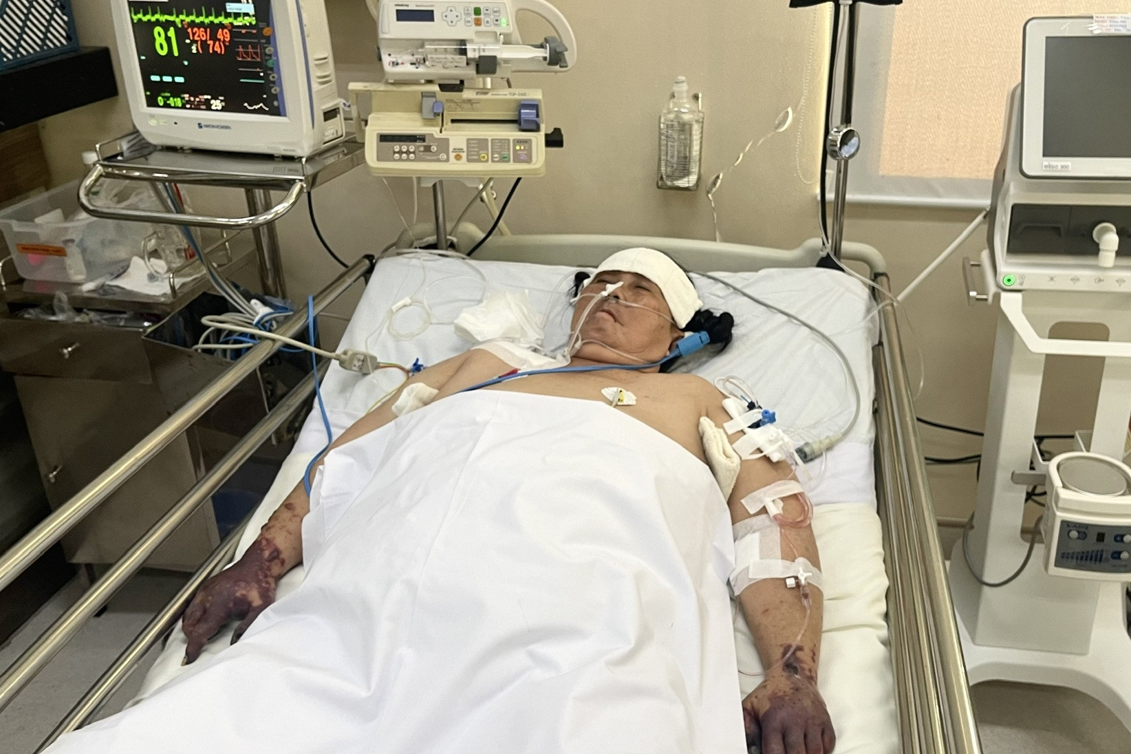 Người phụ nữ có nguy cơ cắt bỏ tứ chi vì nhiễm MRSA cần giúp đỡ