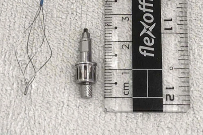 Người đàn ông bị dụng cụ nha khoa rơi vào phổi khi làm răng