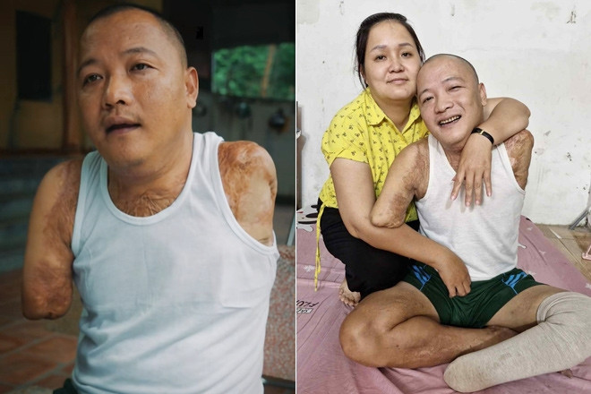 Mất 2 tay 1 chân sau tai nạn, người đàn ông tìm lại cuộc đời nhờ tình yêu của vợ
