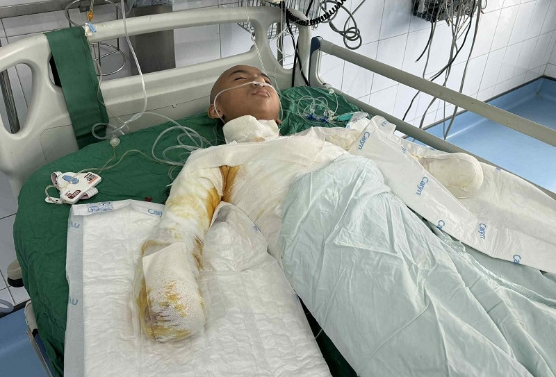 Bé trai 14 tuổi bị bỏng điện cao thế mất cả hai tay, mong được cộng đồng giúp đỡ