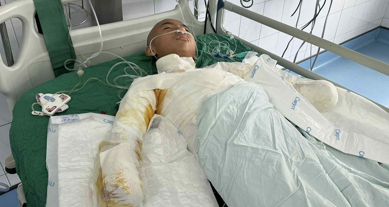 Bé trai 14 tuổi bị bỏng điện cao thế mất cả hai tay, mong được cộng đồng giúp đỡ