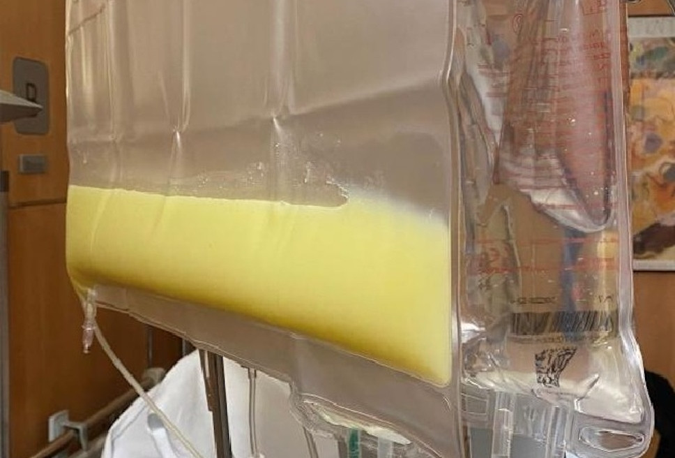 Phải thay huyết tương, lọc máu vì thức uống nam giới thường xuyên dùng