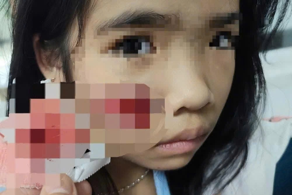 Đang chơi tại sân nhà, bé gái bị khỉ hoang tấn công gây thương tích ở mặt và đầu