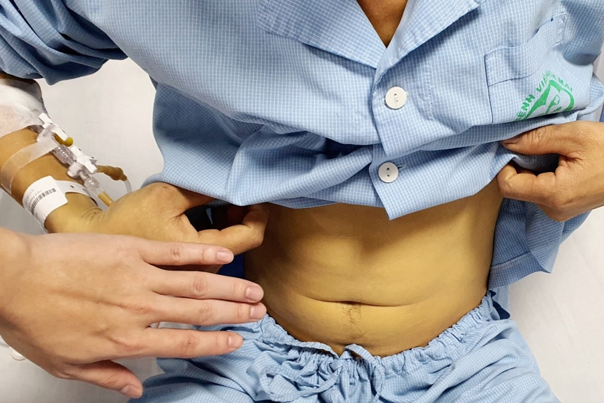 Người đàn ông trẻ suýt tử vong vì uống mật cá trắm để tăng sinh lực