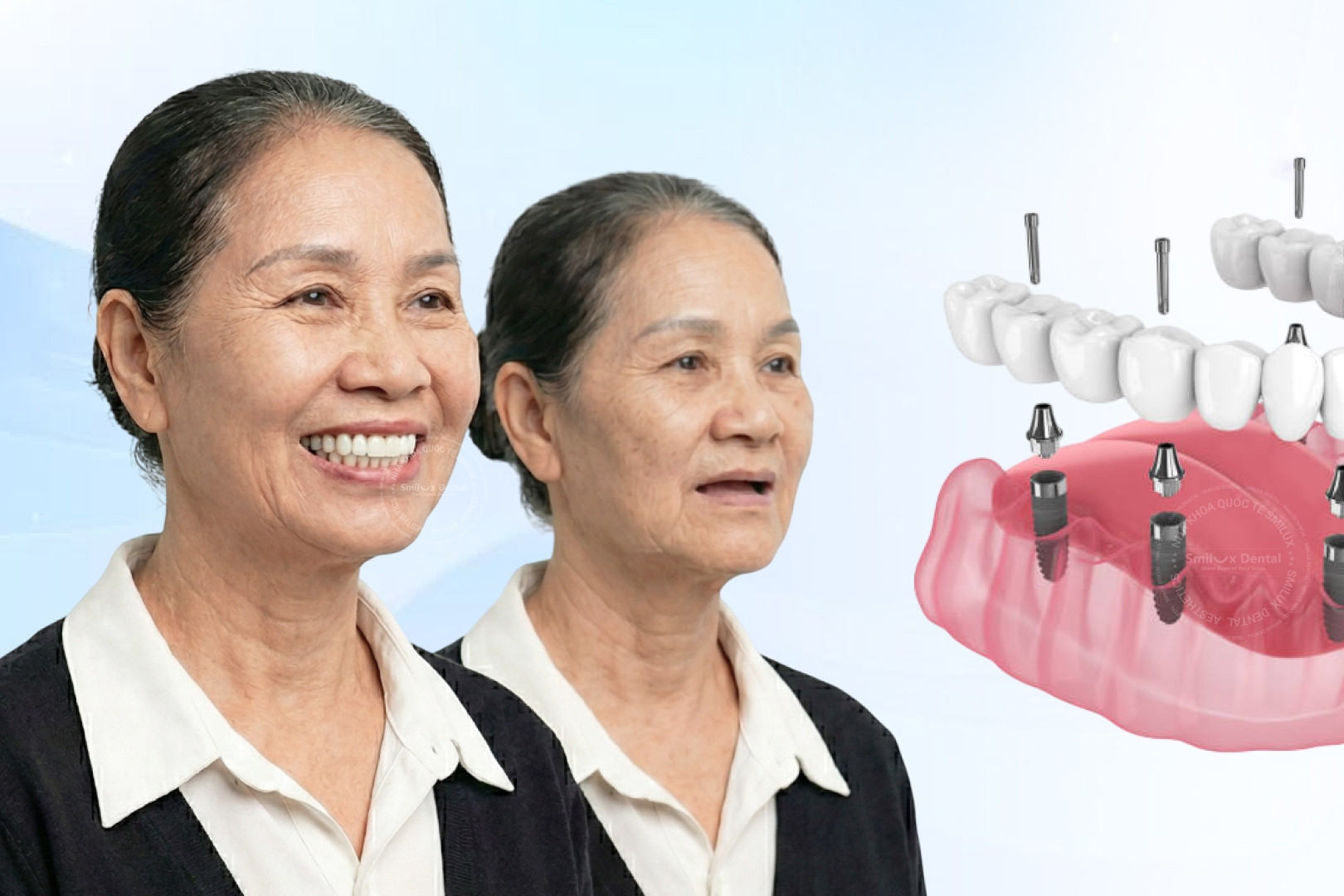 Phục hình răng mất, khôi phục ăn nhai tự nhiên