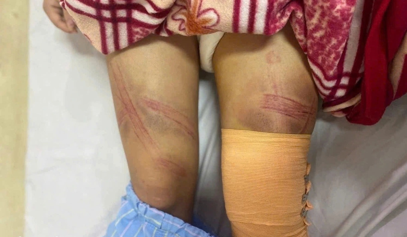 a nữ sinh bị tàn tật.webp