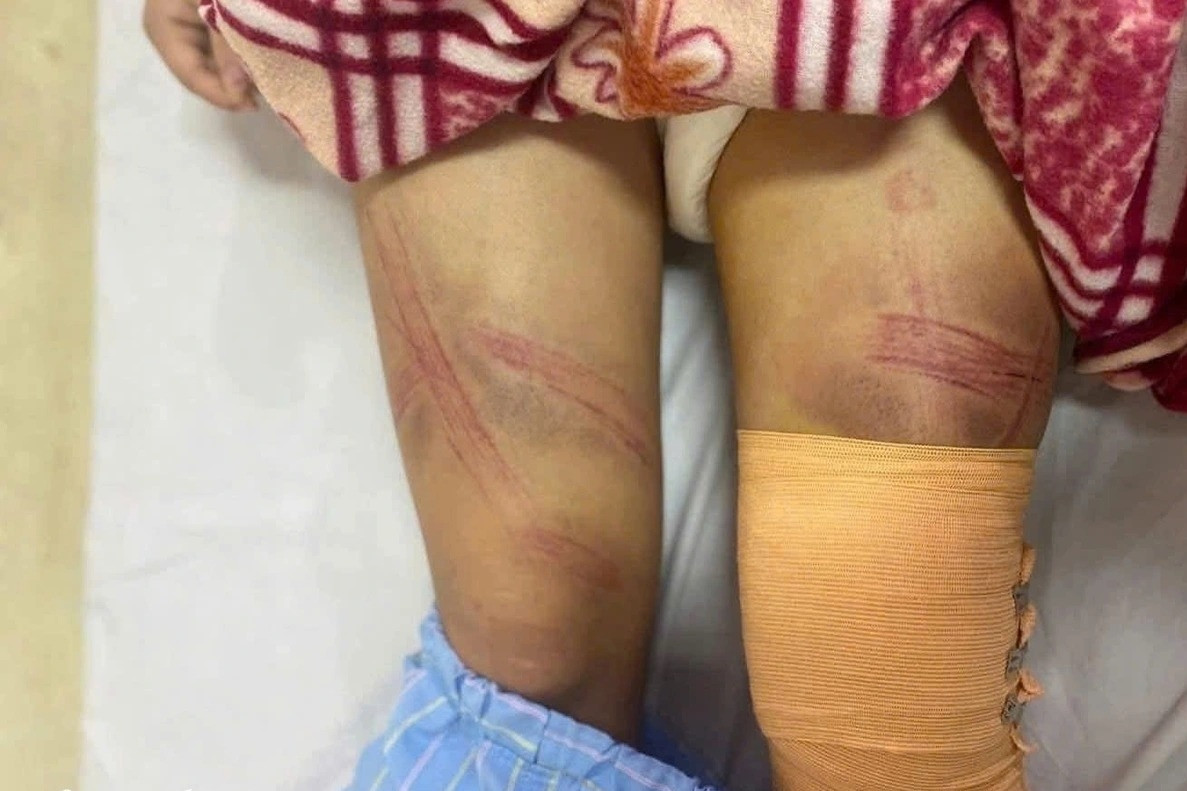 Nữ sinh lớp 7 ở Nghệ An nhập viện nghi do bị bố bạo hành