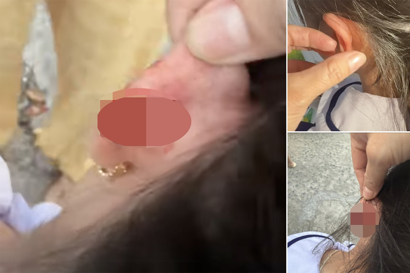 Phụ huynh ‘tố’ giáo viên chủ nhiệm véo chảy máu tai học sinh lớp 1