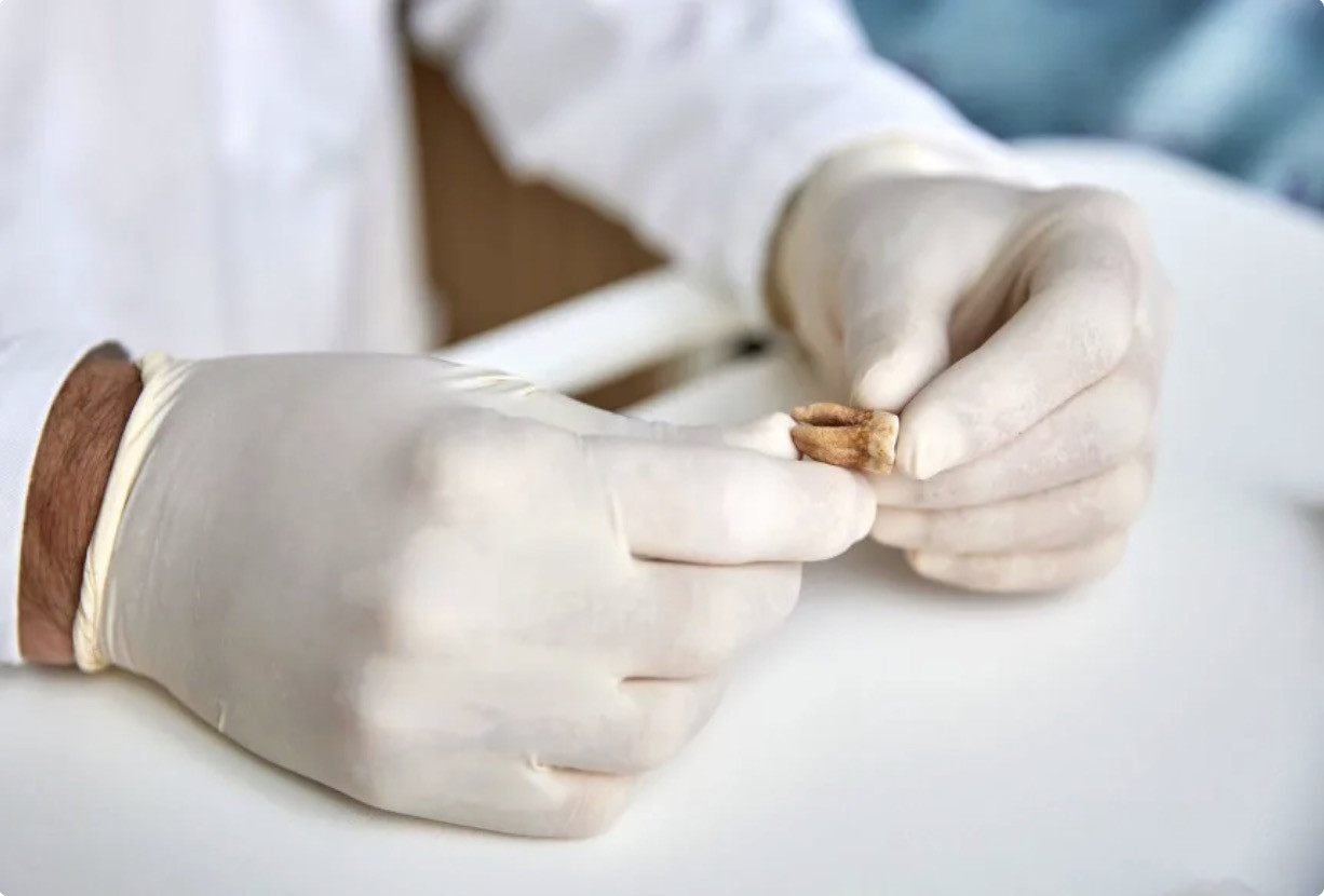 Một chiếc răng được sử dụng để phân tích ADN cổ đại trong quá trình nghiên cứu quân đội của Napoléon. Claudio Centonze/Ủy ban Châu Âu