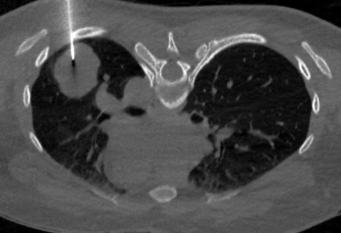Người phụ nữ trẻ mắc ung thư từ dấu hiệu giống có thai