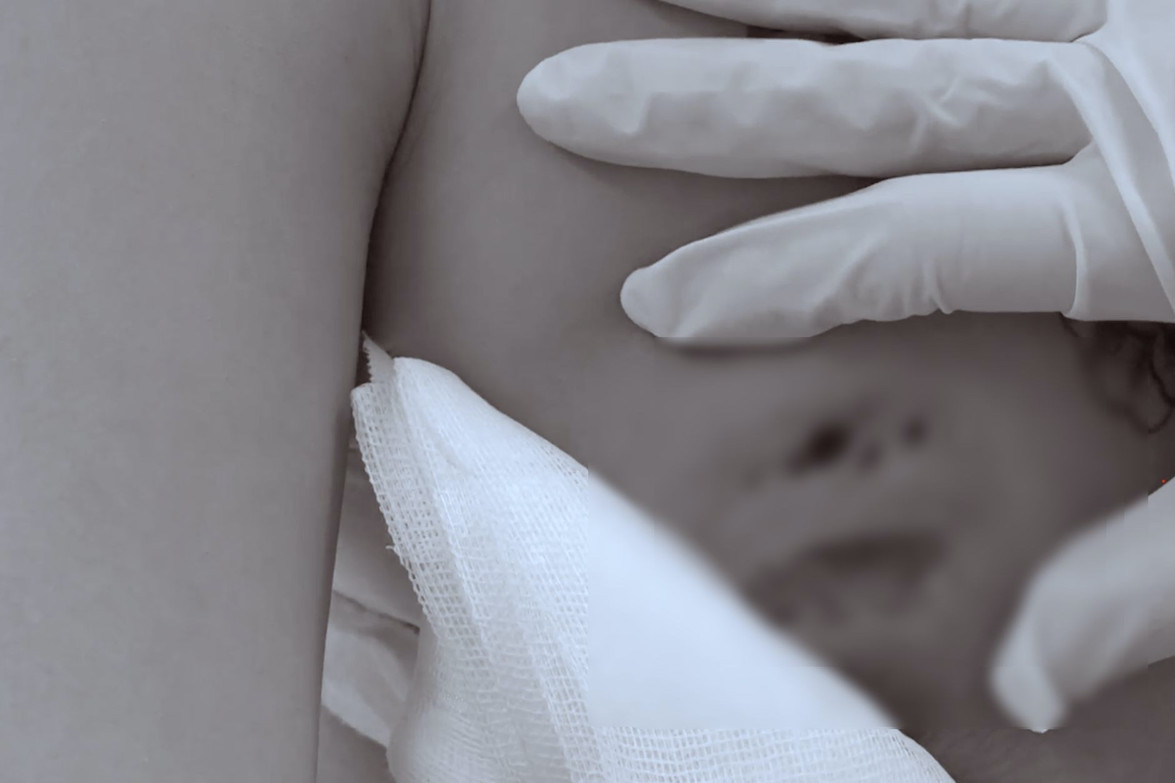 Cô gái nhập viện vì áp xe nặng sau tiêm filler nâng vòng một