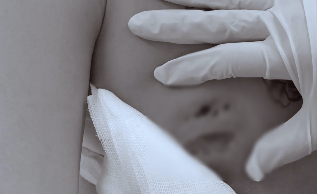 Cô gái nhập viện vì áp xe nặng sau tiêm filler nâng vòng một tin vao quang cao lam dep tren mang co gai dinh ap xe bien dang vu.jpg