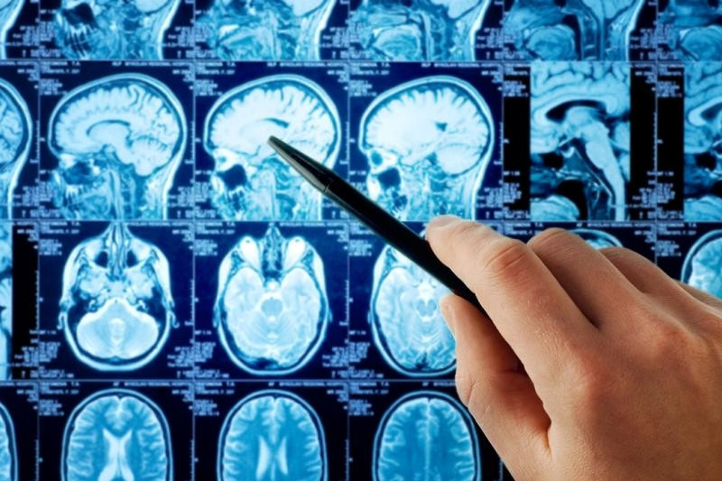 Trẻ 8 tuổi đã bị đột quỵ, dấu hiệu dễ nhầm lẫn với cảm cúm