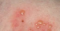 Bé 8 tuổi mắc bệnh da hiếm gặp khiến toàn thân có nhiều bọng nước căng phồng