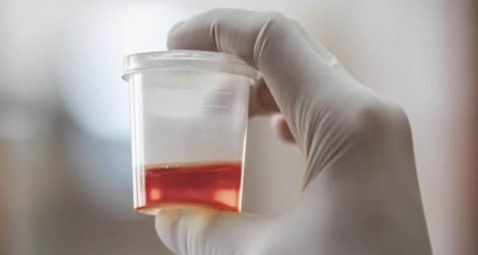 Sợ hãi khi nước tiểu có màu đỏ tươi