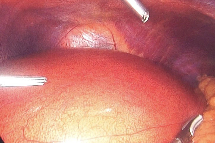 gan nhiem mo 131.png