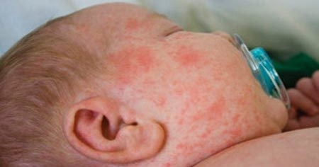 Bé 2 tuổi tử vong sau 12 giờ đến viện cấp cứu, nghi do sởi