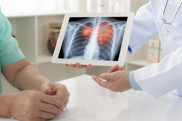 Căn bệnh khiến người đàn ông có 72 lỗ thủng trong phổi, mất khi 28 tuổi