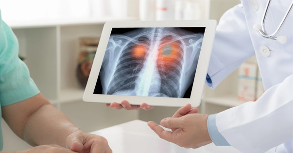 Căn bệnh khiến người đàn ông có 72 lỗ thủng trong phổi, mất khi 28 tuổi