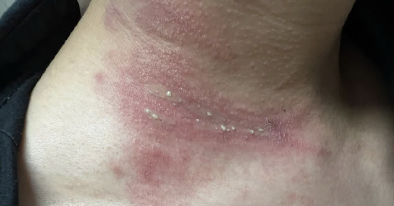 Loài côn trùng bé bằng hạt gạo có độc tính mạnh gấp 12 - 15 lần nọc rắn hổ