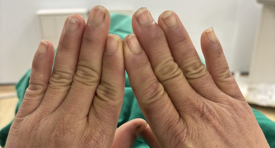 Mắc chứng bệnh lạ, người phụ nữ đau đớn mỗi khi chạm tay vào nước