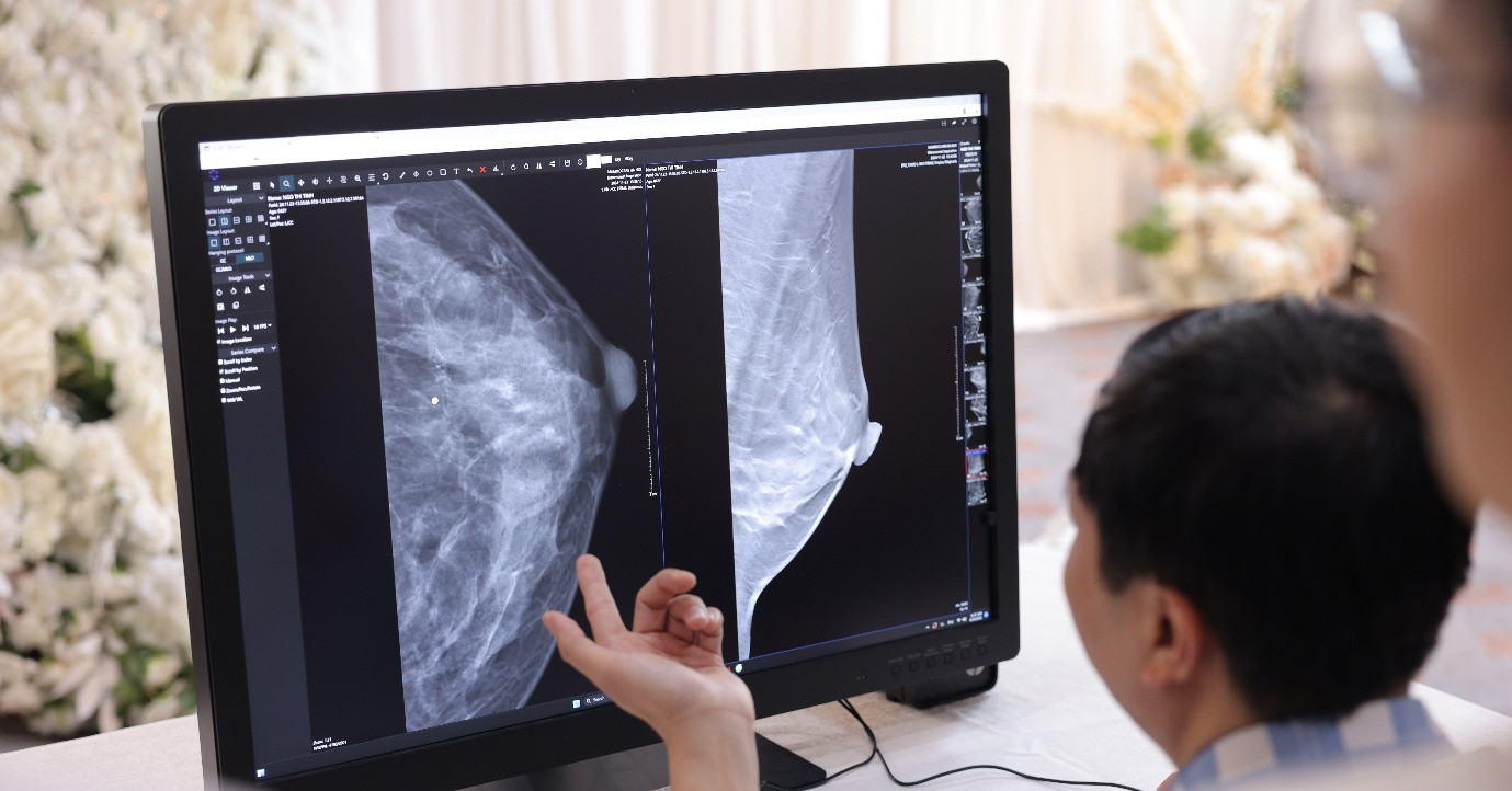 Cách mạng hóa điều trị ung thư vú với công nghệ AI tại Việt Nam