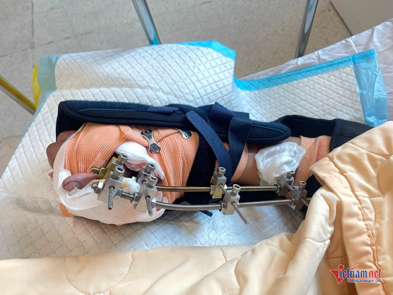 W-Dập nát bàn tay 2.JPG.jpg