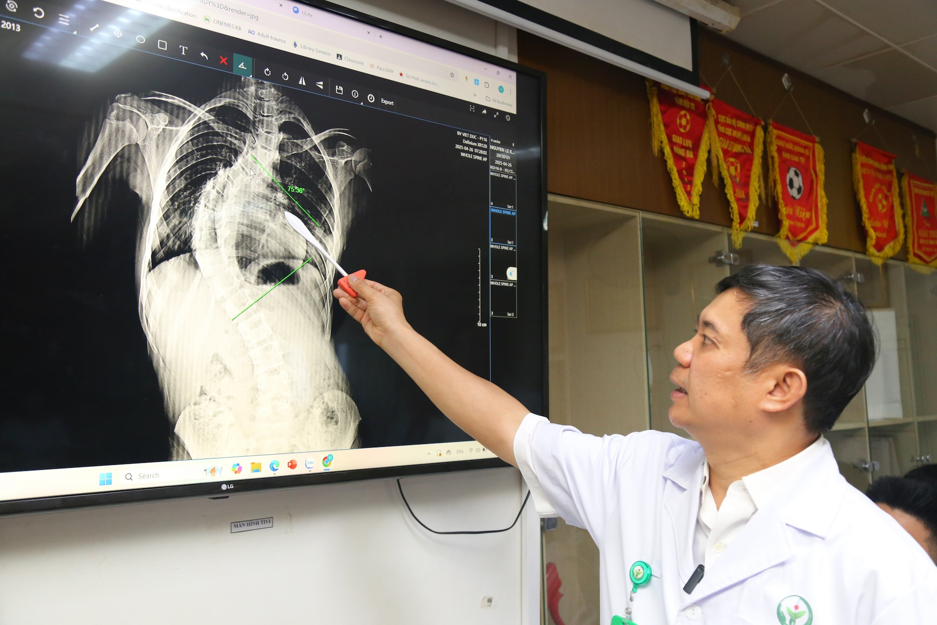 Bé gái 13 tuổi ở Hà Nội có cột sống cong hình chữ C, uốn "như con rồng"