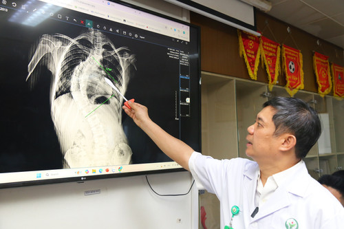 Bé gái 13 tuổi ở Hà Nội có cột sống cong hình chữ C, uốn 'như con rồng'