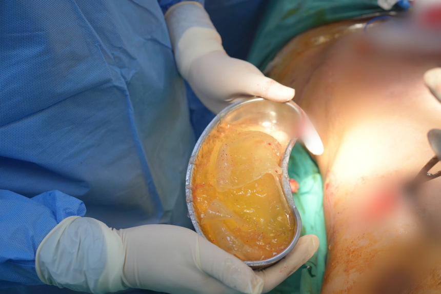 Thai phụ hoảng loạn vì vỡ túi nâng ngực