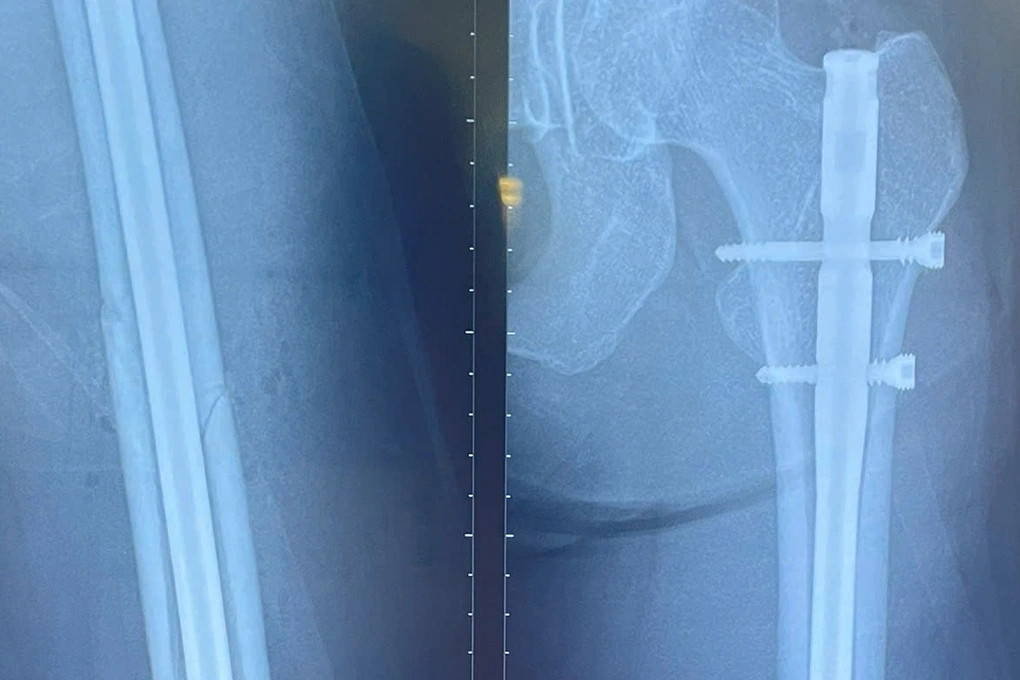 Nữ người mẫu cao 1m78 ở TPHCM gãy xương đùi trên sân pickleball