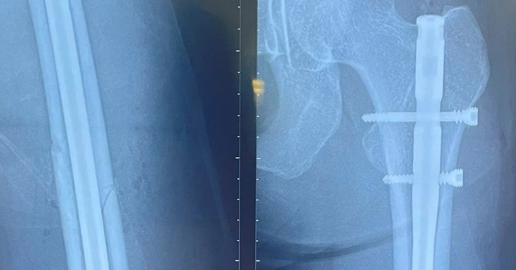 Nữ người mẫu cao 1m78 ở TPHCM gãy xương đùi trên sân pickleball