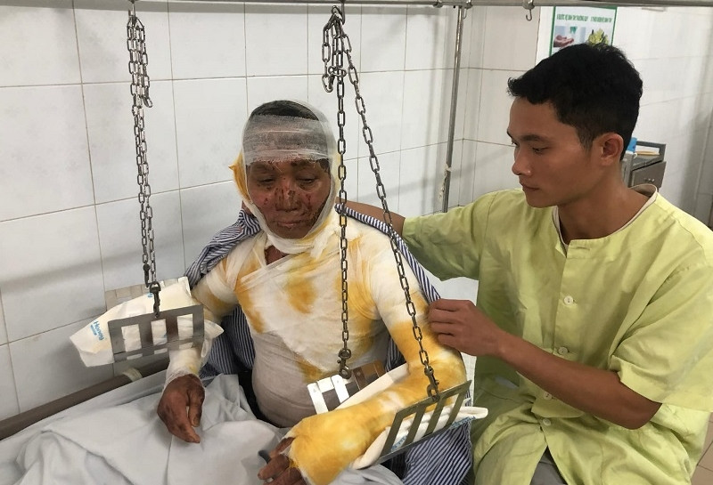 Đưa bố bỏng nặng đi cấp cứu, con trai nghèo chỉ có vài trăm nghìn đồng trong túi