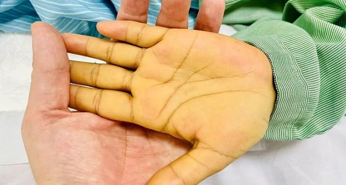 Người phụ nữ bị hôn mê, trong máu có hàng tỷ virus viêm gan B