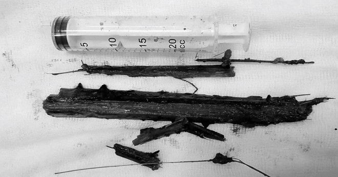 Cành cây dài 20cm nằm trong lồng ngực cụ bà suốt 2 năm