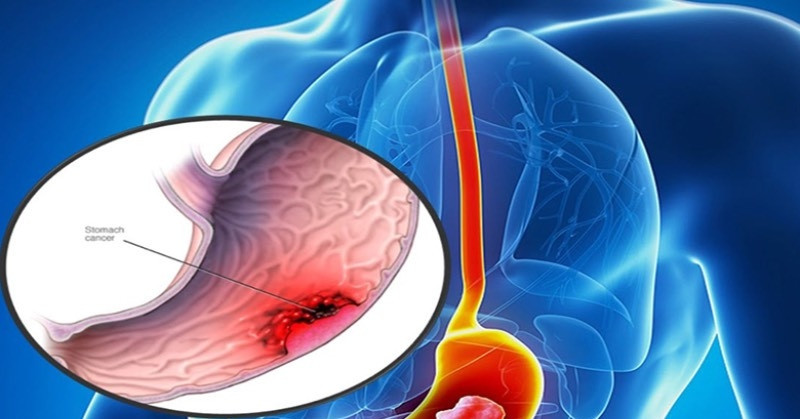 Phát hiện ung thư từ dấu hiệu chóng mặt