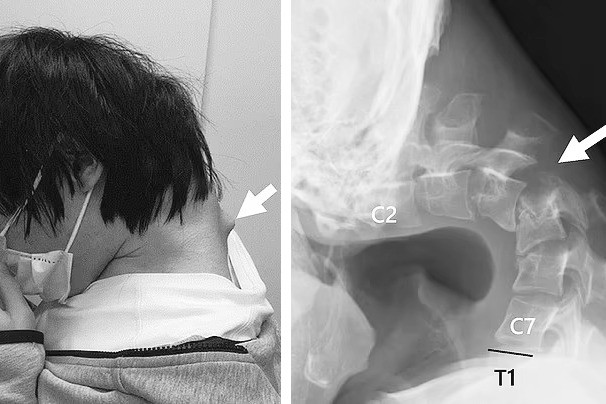 Hình ảnh cổ vẹo vọ đáng sợ của nam thanh niên vì sở thích quen thuộc