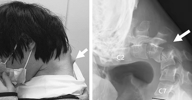 Hình ảnh cổ vẹo vọ đáng sợ của nam thanh niên vì sở thích quen thuộc