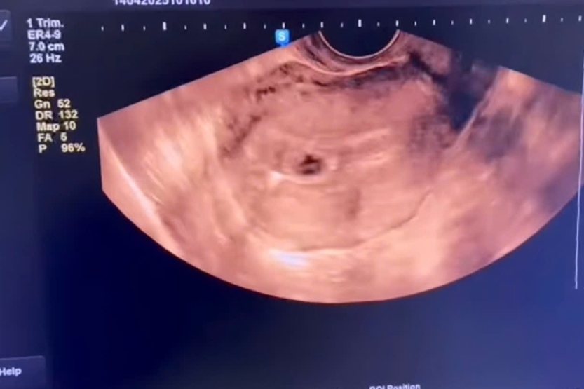 Người phụ nữ mang thai dù đặt vòng từ 4 năm trước