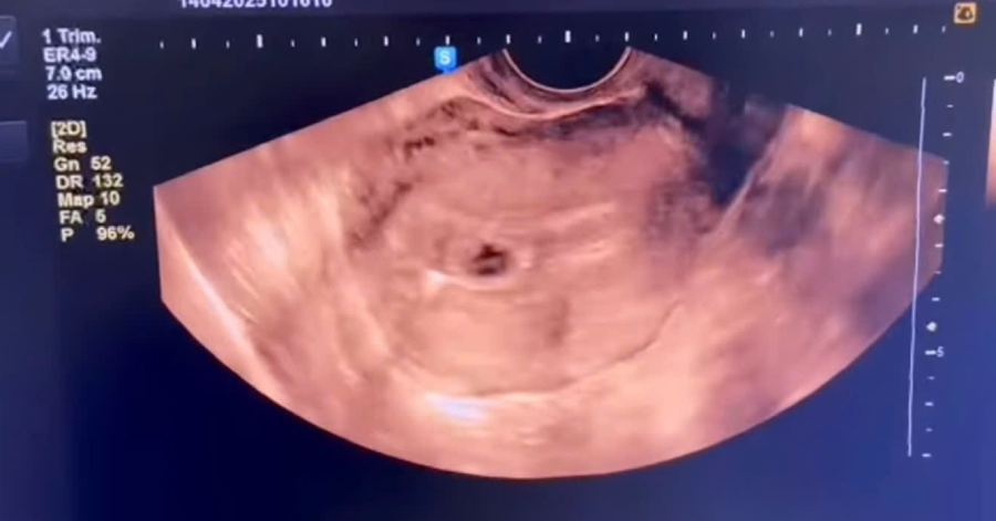 Người phụ nữ mang thai dù đặt vòng từ 4 năm trước