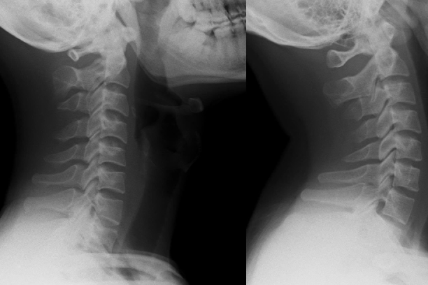 Nam thanh niên cột sống 'thẳng như cây gậy' vì thói quen triệu người mắc