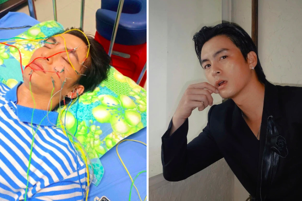 Diễn viên Lãnh Thanh bị liệt dây thần kinh số 7