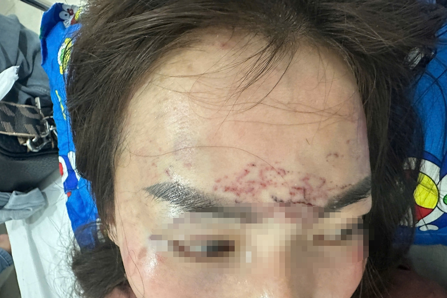 Khởi tố vụ người phụ nữ đi đường bất ngờ bị kéo lên ô tô, 'tra tấn' bằng axit