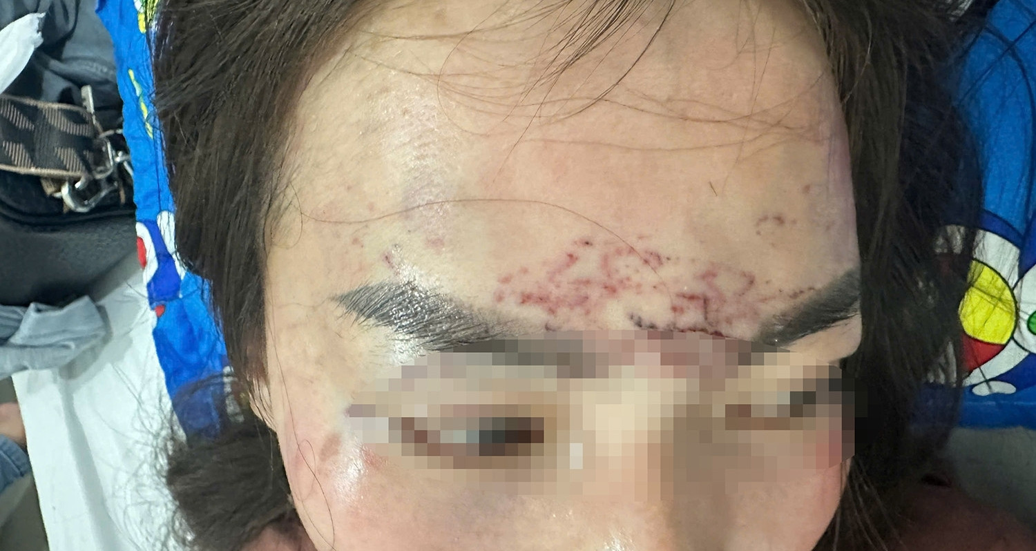 Khởi tố vụ người phụ nữ đi đường bất ngờ bị kéo lên ô tô, 'tra tấn' bằng axit