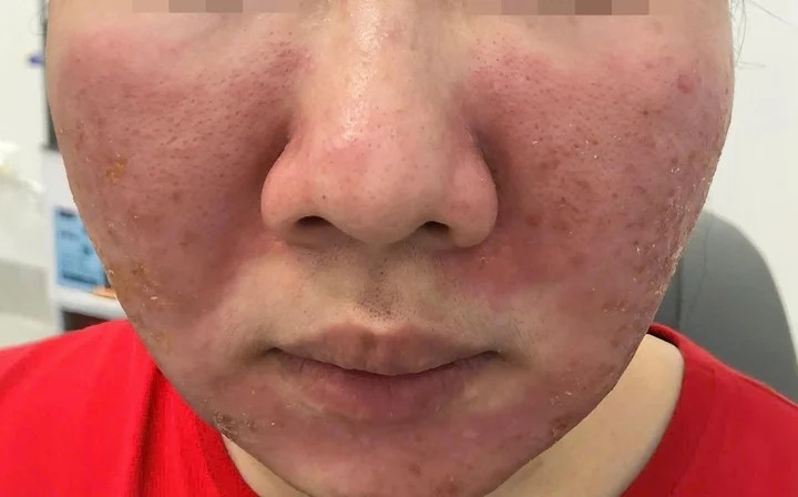 viem da tiep xuc 06002746.webp